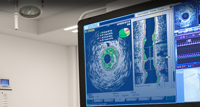 VH IVUS
